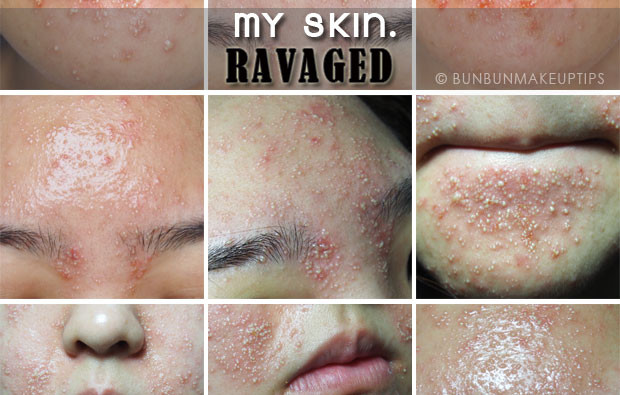 My Horrific Post-Facial Experience. You Need To Read This.